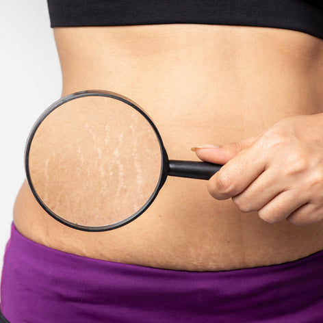 Stretch Marks